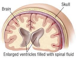 Τι είναι ο υδροκέφαλος παθολογική αύξηση της ποσότητας εγκεφαλονωτιαίου υγρού εντός της κρανιακής κοιλότητας που αντανακλά σε αύξηση
