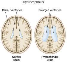 Αιτιοπαθογένεια υδροκεφάλου Αυξημένη παραγωγή, μειωμένη απορρόφηση ή απόφραξη της