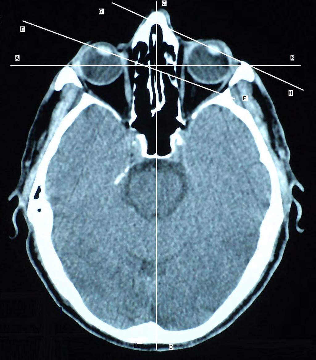 απώλεια της διαφοροποίησης μεταξύ φαιάς και λευκής ουσίας (loss of differentiation between gray and white matter) και η υπέρπυκνη μέση εγκεφαλική αρτηρία (hyperdensity of middle cerebral artery).