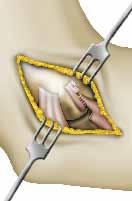 Η επέμβαση που σας προτείνουν Η επέμβαση Συρραφή τομής Χρειάζεται μετάγγιση ; Ο χειρουργός πραγματοποιεί μια τομή σε σχήμα «Z» στον εκτείνοντα μυ.