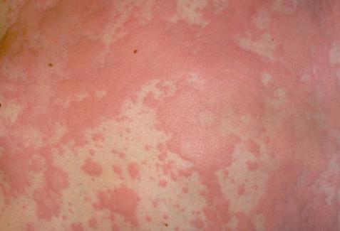 ΣΥΜΠΤΩΜΑΤΑ Αλλεργίες του δέρματος: Εμφανίζονται σε περιοχή του δέρματος με : -κοκκινίλα -φαγούρα -ελαφρύ πρήξιμο