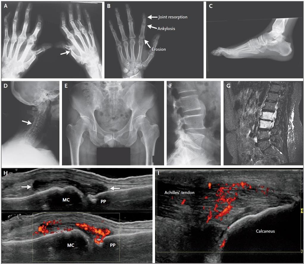 Ακτινολογικά χαρακτηριστικά της ψωριασικής αρθρίτιδας Panel A show arthritis mutilans, with pencil-in-cup deformities (arrow) and marked bone resorption (osteolysis) in phalanges of the right hand.