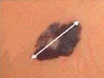 Vyšetrenie robí dermatológ pomocou prístroja, ktorý sa volá dermatoskop. Skúsený dermatológ dokáže zhodnotiť dané znamienka a určiť postup liečby.