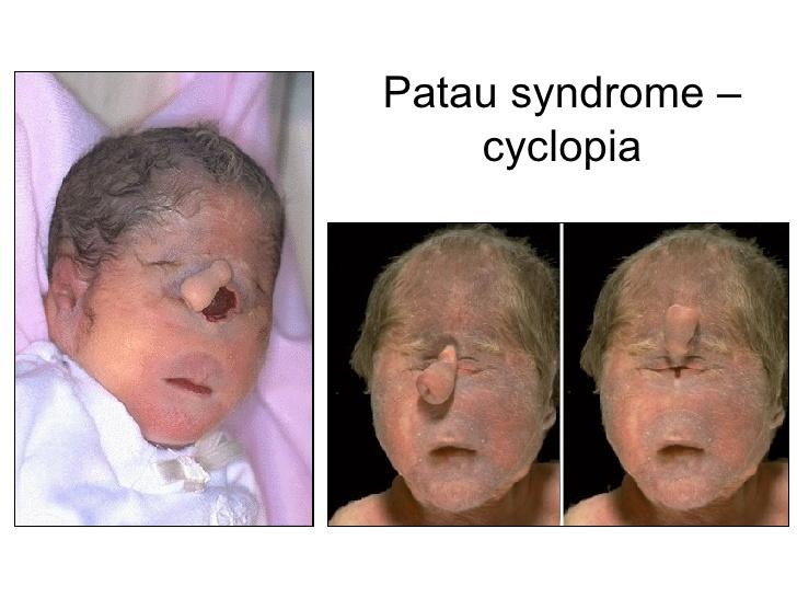 com /Trisomy+13+(Patau+Syndrome) Εικόνα 11.