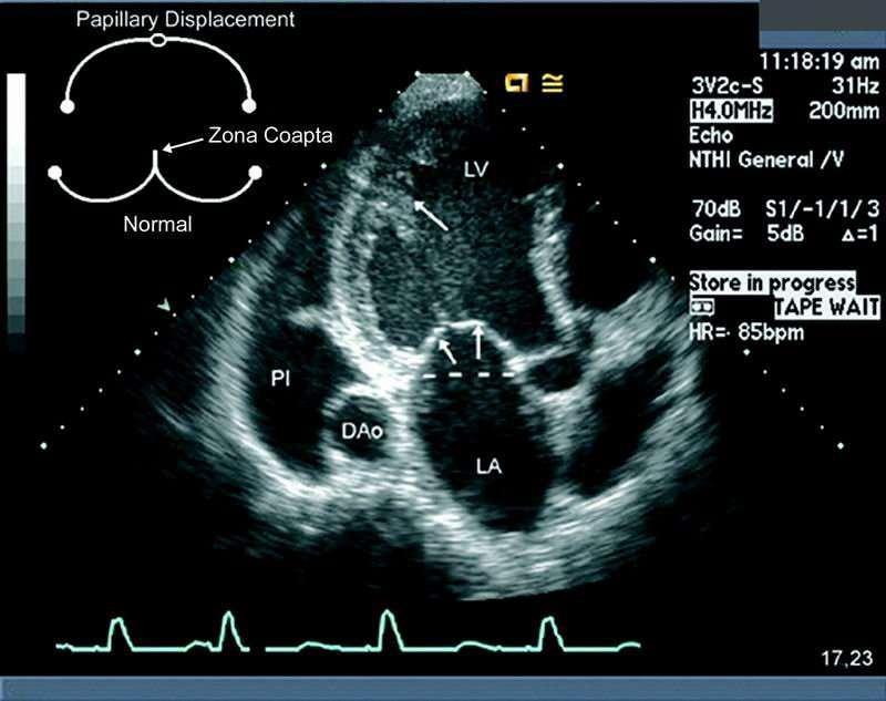 ECHO displacement of