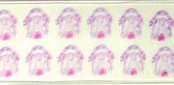 Follicular cell hypertrophy Follicular cell hyperplasia Additional criteria
