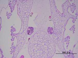 Thyroid hypertrophy G G G3 G4 G5 