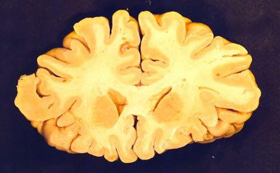 Genu of CC Cingulate gyrus Anterior horn of