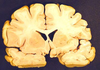 Body of CC Septum Pellucidum Rostrum of CC Head of Caudate Nucleus