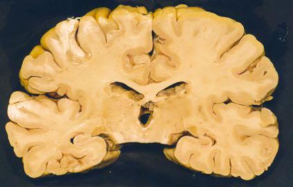 Body of Caudate Nuleus Body of CC Thalamic Pulvinar Posterior Limb of