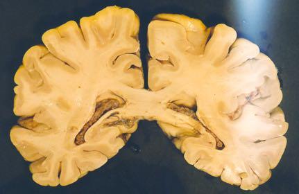 Body of Caudate Nucleus Splenium of CC Choroid Plexus Hippocampus
