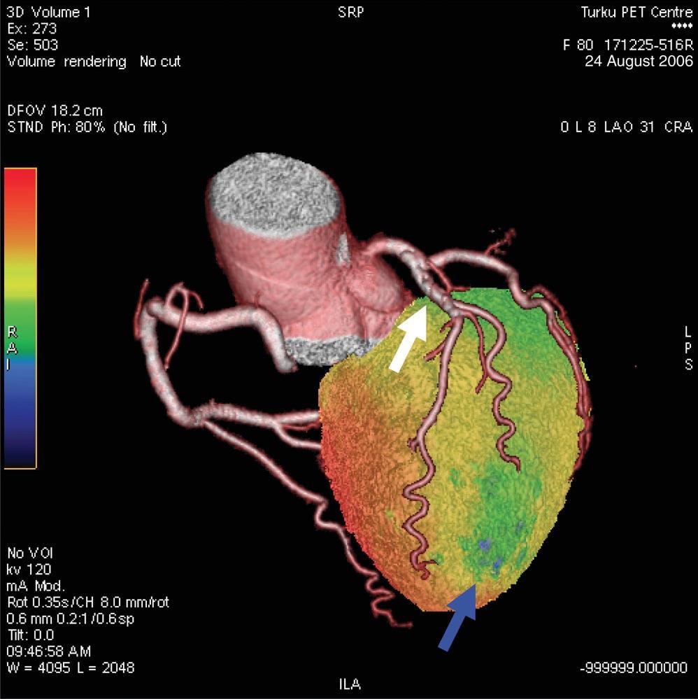 Fusion PET - Cardiac CT Schroeder S et al.