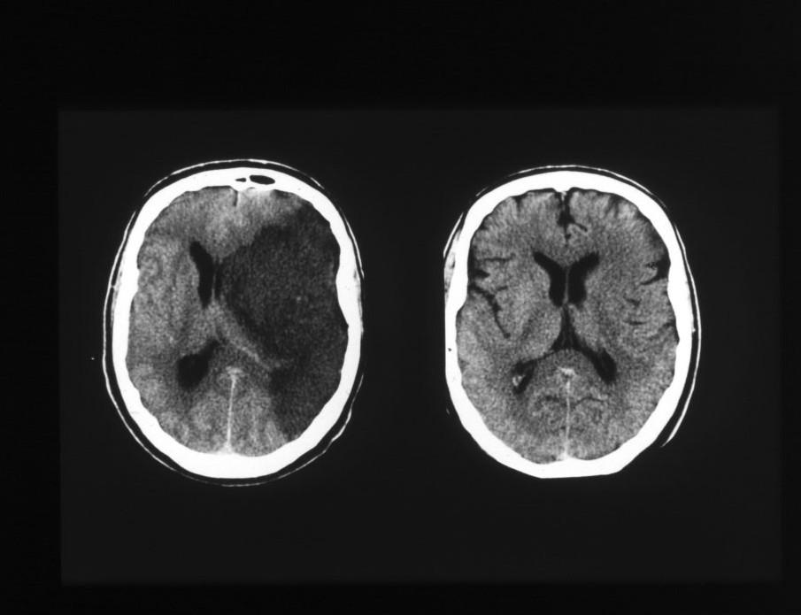 Διαγνωστική προσέγγιση Σε όλους τους ασθενείς: CT εγκεφάλου ή/και MRI εγκεφάλου