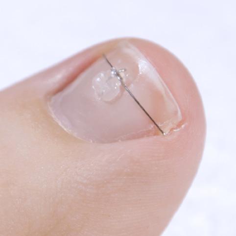 Passend für jede Nagelbreite Teilvorgefertigtes Häkchen Modernes PLUS+ Pad Η μοναδική, πατενταρισμένη τεχνολογία εγγυάται τέλεια εφαρμογή