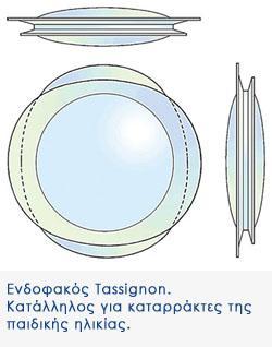 7. Οι ενδοφακού Tassignon εύναι ειδικό κατηγορύα ενδοφακών για τουσ καταρρϊκτεσ παιδικόσ ηλικύασ.