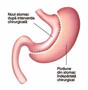 CUM SǍ PREVII? Ce este operația de gastric sleeve?