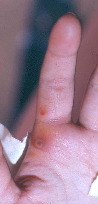 Septic arthritis Συνήθως μεγάλες αρθρώσεις Ιστορικό νόσου