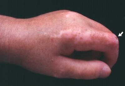 Systemic sclerosis Ulceration (arrow) and dyschromic changes
