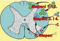 Hirurški aspekti oboljenja kičmenog stuba KLINIČKA PROCENA STEPENA OŠTEĆENJA Stepen 1 - Bol je lokalizovan u predelu kičmene moždine, a pacijent je bez neurološkog deficta.