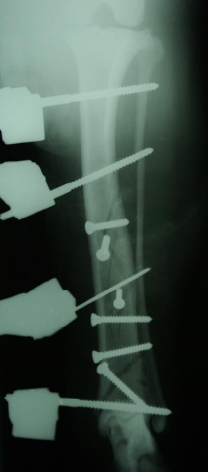 A B C (A) Sagitalni rendgenogram stabilizacije