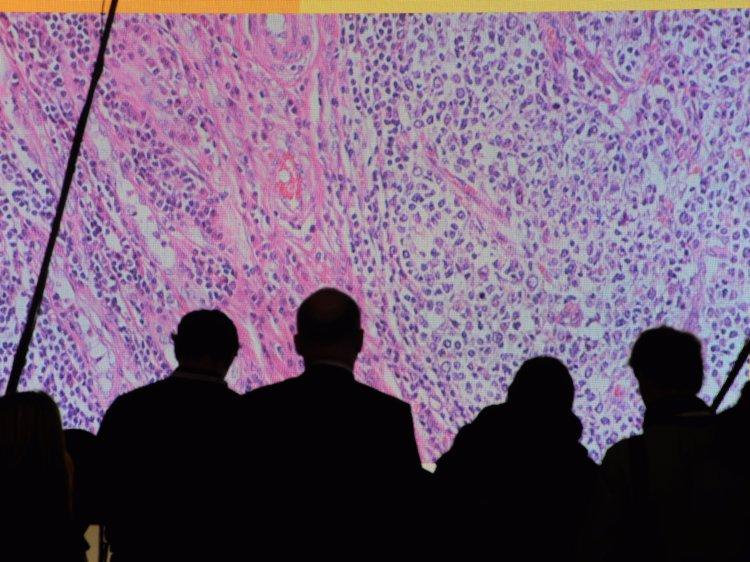 Cancer cells are seen on a large screen connected to a microscope at