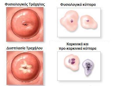 ΚΕΦΑΛΑΙΟ 2 ο : ΓΕΝΙΚΑ ΠΕΡΙ ΝΕΟΠΛΑΣΙΩΝ ΤΗΣ ΜΗΤΡΑΣ 2.