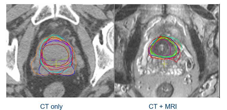 Παράδειγμα Ακτινοθεραπείας με Γ.Ε. 12 Ο Ακτινοθεραπευτής σχεδιάζει (στο TPS), πάνω στις εικόνες αξονικής τομογραφίας (CT), τους καρκινικούς όγκους που πρέπει να ακτινοβοληθούν.