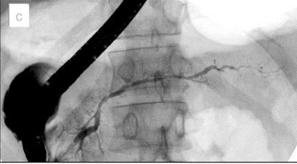 pancreas )/παγκρ. μάζα.
