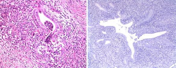 Δ2. Ιdiopathic duct-centric pancreatitis (IDCP). Τύπου 2 ΑΙΡ-GELs (+) Λεμφοπλασματοκυτταρική διήθηση που περιβάλλει τους πόρους, + ίνωση.
