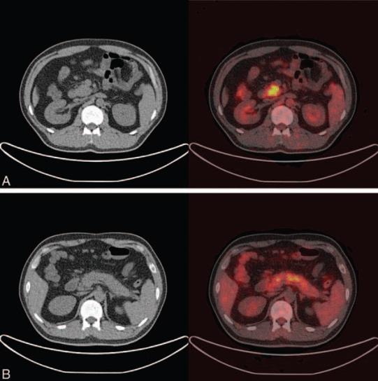 PET- scan. - Πρόσληψη σκιαγραφικού σε εξωπαγκρεατικά όργανα. (Σιελογόνοι αδένες, δακρυικοί, νεφροί ). Δ. ΕU