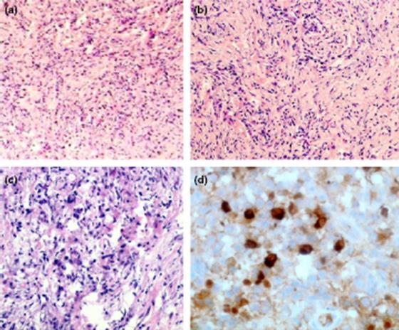 ΙΙ. IgG4 related sclerosing cholangitis (ΙgG4-SC) 2009: IgG4-related sclerosing cholangitis (IgG4-SC), αντί του IgG4-associated cholangitis. Stone JH et al.