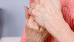 primenu antiinflamatornih lekova OSTEOARTRITIS - oblik hroničnog artritisa kod koga je hrskavica oštećena, tečnost u zglobovima normalna ili blago upaljena, prostor u zglobovima sužen, usled čega