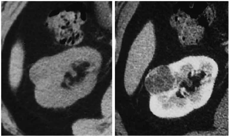 ΔΙΑΦΟΡΙΚΗ ΔΙΑΓΝΩΣΗ ΕΙΚΟΝΑ 4. Καρκίνος δεξιού νεφρού, όπως απεικονίζεται στην ελικοειδή αξονική τομογραφία πριν (αριστερά) και μετά (δεξιά) από τη χορήγηση σκιαγραφικού μέσου.
