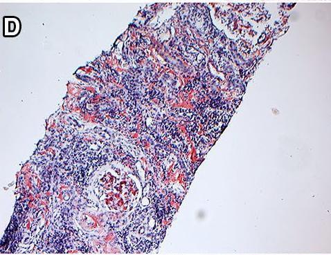 LEUKOCYTE CHEMOTACTIC FACTOR 2 (ALECT2) ΑΜΥΛΟΪΔΩΣΗ Διάχυτη προσβολή του νεφρικού φλοιού Προσβολή μυελού: απούσα ή σπάνια Χαρακτηριστικές