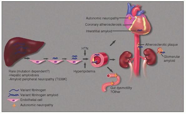 ΑFIB (FIBRINOGEN A-CHAIN AMYLOIDOSIS) Η συχνότερη ίσως μορφή κληρονομικής νεφρικής αμυλοείδωσης Αξιοσημείωτος νεφρικός τροπισμός Πρωτεϊνουρία + νεφρική ανεπάρκεια Μετάλλαξη στο ινωδογόνο