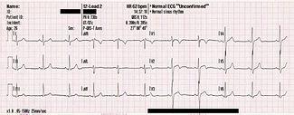 θορύβου 50Hz από το σήμα ECG  ΕΝΟΤΗΤΑ 1 ΔΙΑΛΕΞΗ