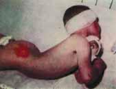 1.2009 sa očkujú všetky dojčatá po dovŕšení desiateho týždňa života hexa vakcínou proti záškrtu, tetanu, čiernemu kašľu (acelulárna zložka), detskej obrne, hemofilovým invazívnym infekciám, vírusovej