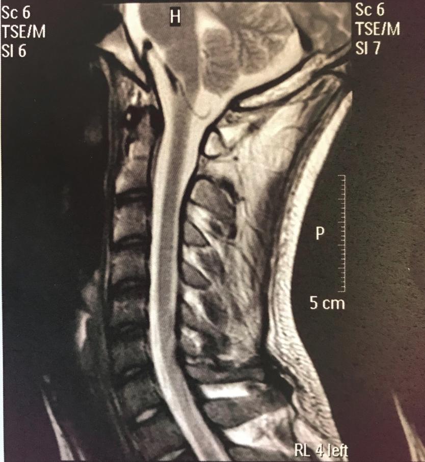 Απεικόνιση: MRI ΑΜΣΣ-ΘΜΣΣ-ΟΜΣΣ