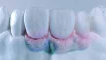G5) Basic Gingiva