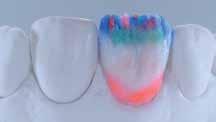 aplikacija: Deep dentin, Dentin,