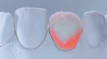 cervikalnog dijela fasete Dentin,