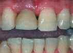 16 Kλινικές τεχνικές DENTAL TRIBUNE Greek Edition 7 8 9 10 11 12 13 14 15 16 17 18 19 20 21 22 DT σελίδα 15 ση µε τεχνικές προώθησης και απελευθέρωση περιοστέου.