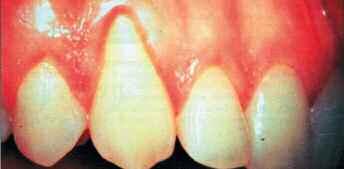 18 Κλινικές Περιπτώσεις DENTAL TRIBUNE Greek Edition Υφίζηση ούλων-αισθητική και προβλέψιµη αντιµετώπιση D.L.Hoexter, BA, DMD, FICD, FACD Ο κόσµος σήµερα επιθυµεί µία αισθητική, νεανική εµφάνιση καθώς και καλή στοµατική υγεία.