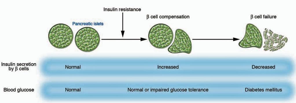 Natural history of Glucose Intolerance and Type 2 Diabetes