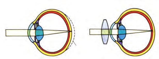 Φυσιολογικός οφθαλμικός βολβός Σε οφθαλμικό βολβό με μικρή προσθοπίσθια διάμετρο το είδωλο κοντινού αντικειμένου σχηματίζεται πίσω από τον αμφιβληστροειδή.