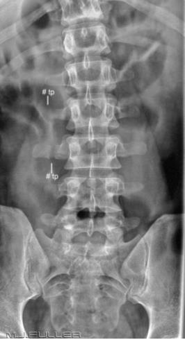 of L3 clearly as well as a similar fracture at L2.