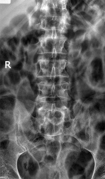 There is improved demonstration of the bony anatomy.