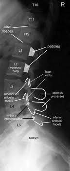 πλάγια προβολή οσφυϊκής μοίρας Pedicles : Vertebral body : Superior