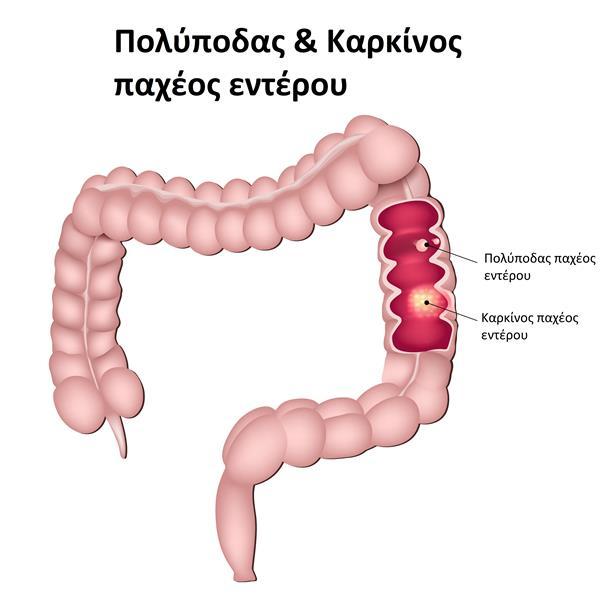 Ο καρκίνος του παχέος εντέρου προκύπτει όταν τα κύτταρα του εντερικού τοιχώματος εμφανίζουν σφάλματα στο γενετικό τους υλικό (DNA), τα οποία με το πέρασμα του χρόνου συσσωρεύονται και οδηγούν σε