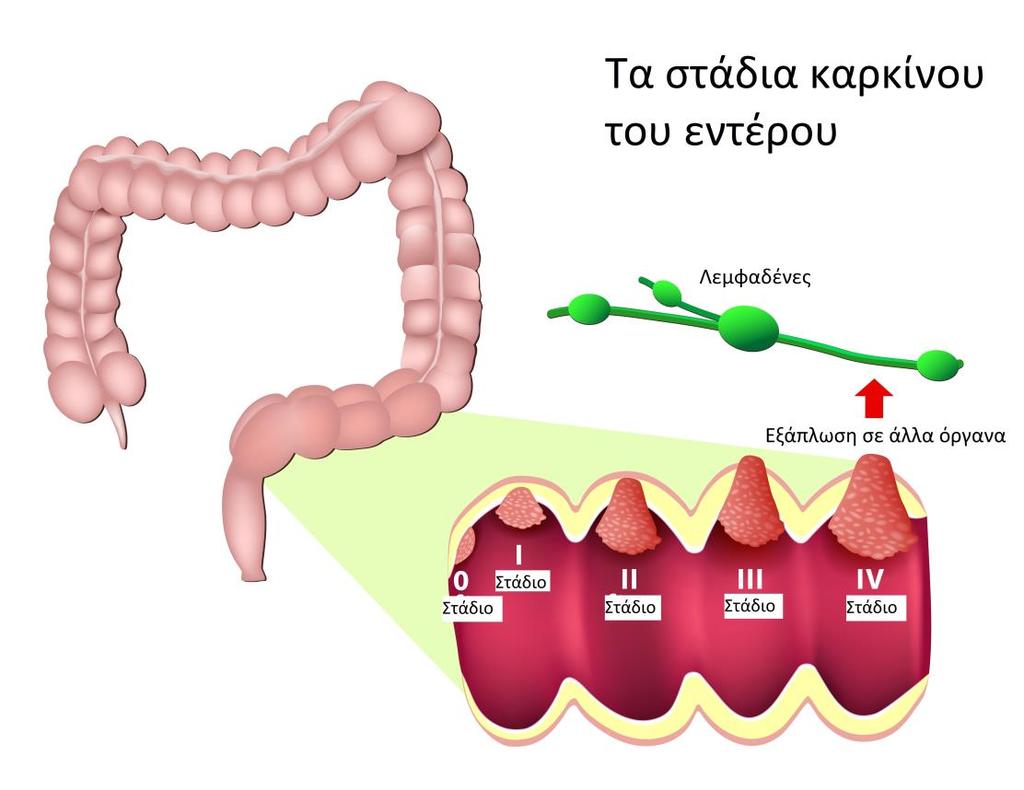 3 P a g e μαγνητική τομογραφία ορθού.